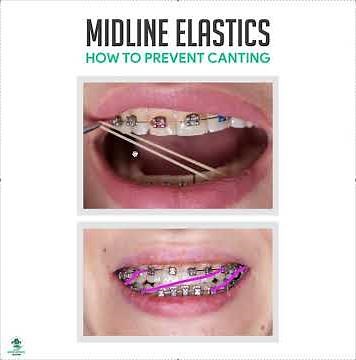 Midline Elastics and Canting