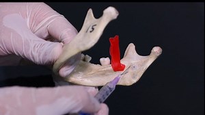 This video will help you understand the landmarks and technique of the Inferior Alveolar Nerve Block. Key points in achieving success while administering this nerve block have been carefully delineated for better understanding by students and practitioners. This nerve block is the cornerstone of achieveing successful pain relief in the lower jaw. Dentists frequently use this technique during dental extractions, Root canal treatment and during surgical placement of dental implants in the mandible