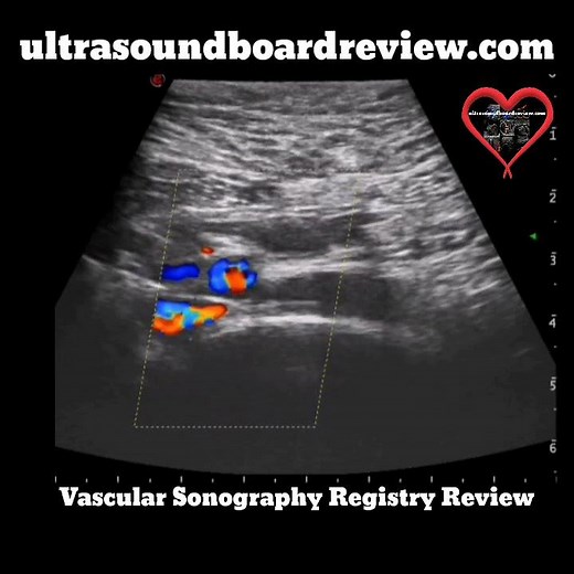 May-Thurner Syndrome Ultrasound