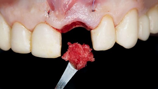 When Does the Blood Clot Go Away After Tooth Extraction? 7 Best Checklists