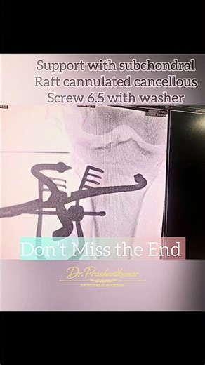 Tibial Plateau Fracture Fixation Surgery | Proximal Tibia ORIF | Knee Fracture