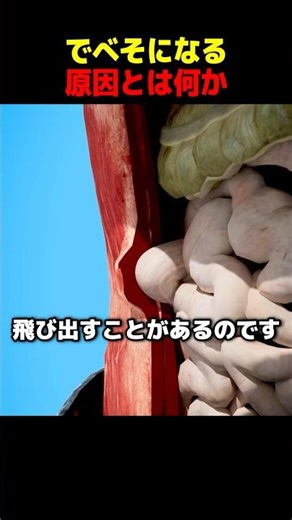 What causes a navel?