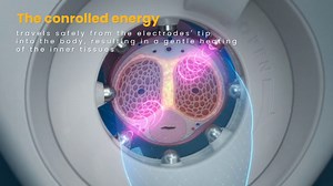 Vertica® // Clinical Info