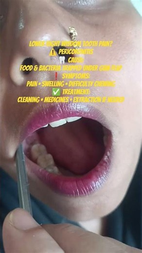 Wisdom Tooth Infection Explained | Pericoronitis Causes & Treatment#thedentalguru