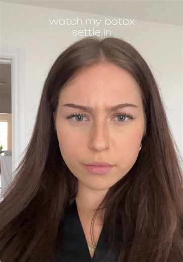 Understanding Baby Botox: Results and Expectations