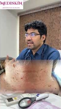 Skin Tags Explained by Dermatologist | Safe Treatment at Mediskin Ongole