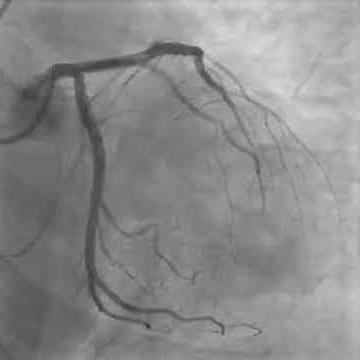 Takotsubo cardiomyopathy