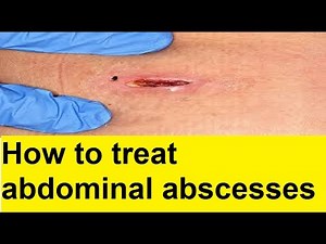 Abdominal Abscesses