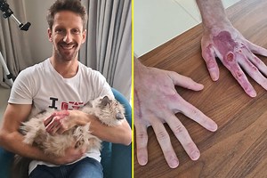 recovery Formula One star Romain Grosjean shows off gruesome hand injuries to reveal full extent of Bahrain horror crash