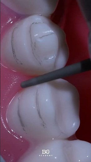 Veneer-lay preparation of premolars. #dentaltraining #dentaleducation