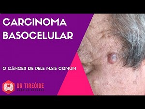 Basal cell carcinoma - The most common type of skin cancer