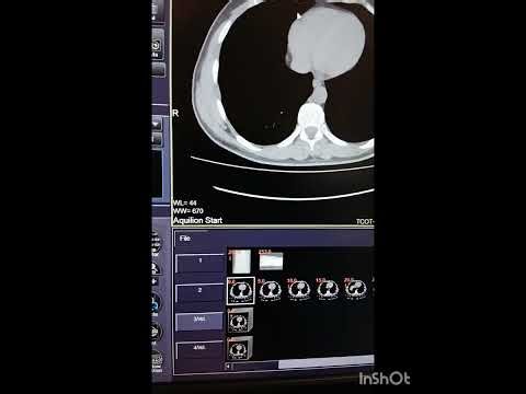 How to Change Patient Information and Use of Raw Data for volume formation
