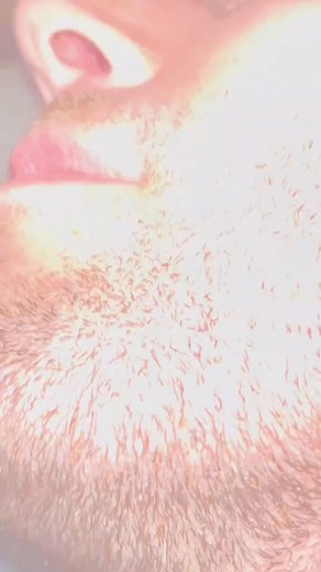 Transform Your Look Instantly! 🌟 Watch Our Ultimate Mustache Removal Guide Using Tweezers for a Smooth Finished #mustacheremoval | April-09-04