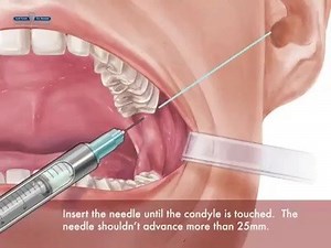5.3K views · 48 reactions | Gow Gates Local Anesthesia Technique....!!! | Dental Videos | Facebook