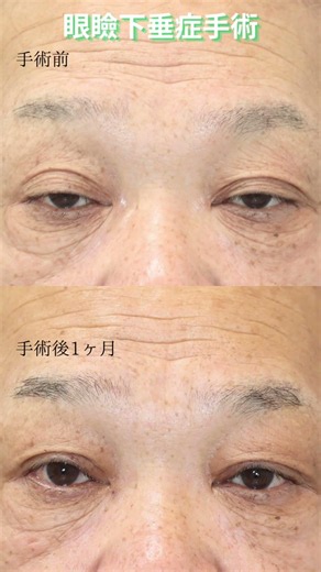 【高齢者 眼瞼下垂症の手術】ビフォア・アフター手術1ヶ月後