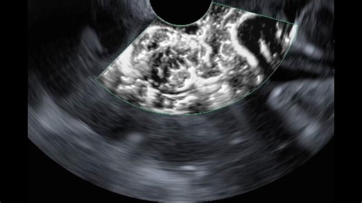 Aplio i800 EUS Processor for Olympus Echoendoscopes: The Dawn of a New Era | Shyam Varadarajulu
