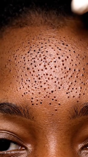 Most Satisfying Blackhead Vacuuming Ever Caught on Camera! | The Farm - Dog TV