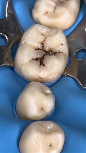 Técnica para realizar resina dental paso a paso