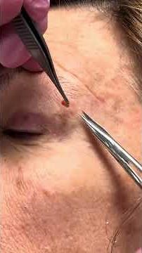 #cystpopping by the eye