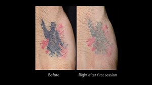 40 reactions · 35 comments | Kristoffer Martin started his laser...