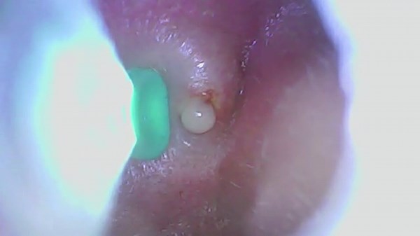 Little explosion from my ear pimple!