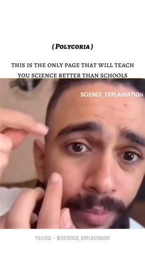 Science | Polycoria is a rare eye condition where a person has two or more pupils in one iris. It can be true polycoria, where each pupil has its own... | Instagram