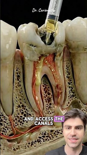 What REALLY Happens In Root Canals