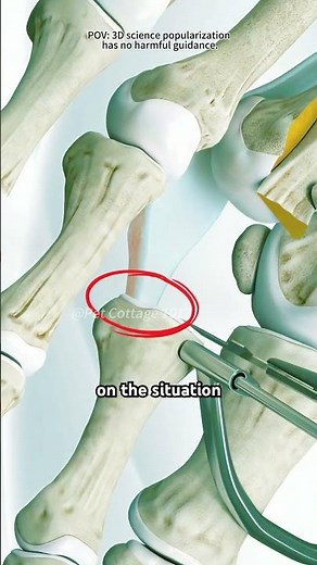 How Hammer Toe Surgery Is Performed (3D Animation)