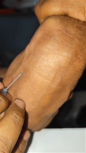 How to Insert Blue Cannula (22G) Step by Step | Nursing Skills | IV Cannula Insertion #shortvideo