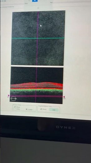 Student extern explains angiography of the retinal vessels.