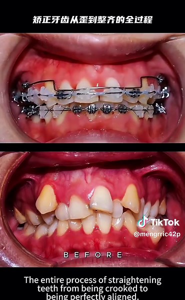 Before and after comparison of teeth alignment#Teeth #Dental #Orthodontic #牙齿矫正 #贴牙片