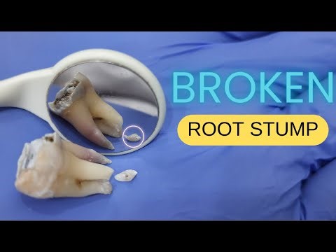 BROKEN ROOT STUMP || When to remove? and When to leave? || Hindi