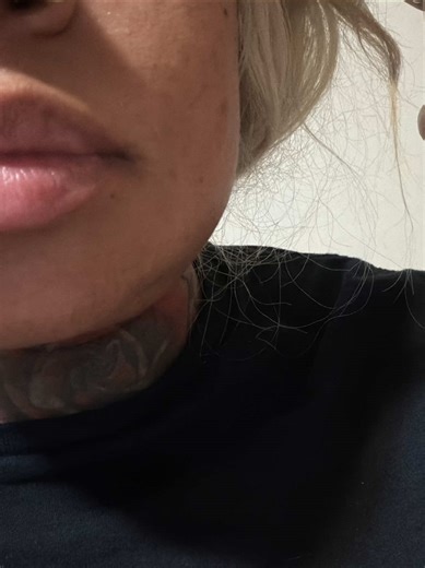 #WisdomTeethRemoval #WisdomTeethRecovery #coronectomyextraction 2026 is full of excitement for me lol. I Had an Oral surgery procedure performed Last Friday. (Top Wisdom tooth extracted, But had a coronectomy performed on the bottom.) Did everything they “Told” me to do, and took my medication as prescribed including antibiotics to PREVENT an infection. Day 3 the swelling would not go down and a painful golf ball sized knot appeared on the side of my face, along with other symptoms. Reached out 