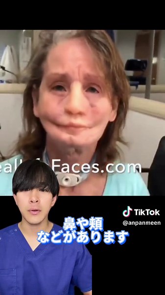 歯科医師のエピテーゼについての解説