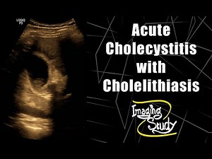 Acute Cholecystitis with Cholelithiasis || Ultrasound || Case 80
