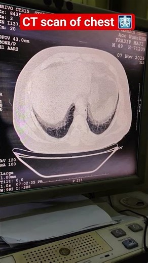 CT chest , ct scan of chest, #radiology #ctscan #chest #doctor #hospital #ct #medical #chestscan