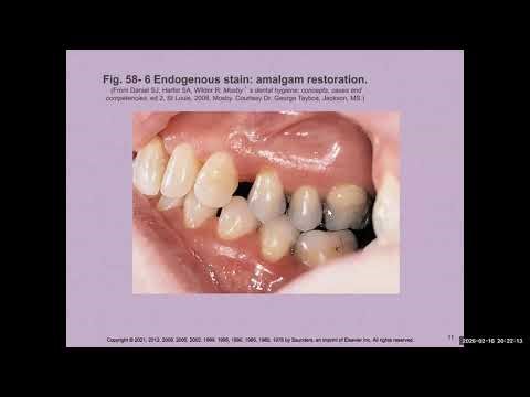 Chapter 58 - Coronal Polishing