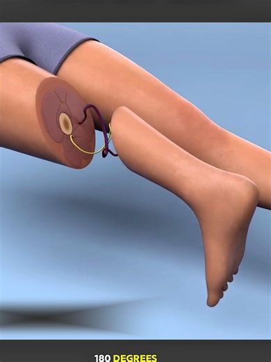 Understanding Rotationplasty Surgery: A Life-Changing Procedure