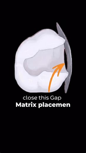 Dr Volodymyr Kachmar | Esthetic & Digital Dentistry on Instagram: "🦷 Class II Composite Restoration — Step by Step A predictable Class II restoration is not about speed, but about following the correct sequence. From proper isolation and matrix placement to layering and finishing — every step matters for: ✔️ tight proximal contact ✔️ correct anatomy ✔️ long-term marginal integrity When each stage is done carefully, composite restorations can be both functional and highly esthetic. 📌 Save this 