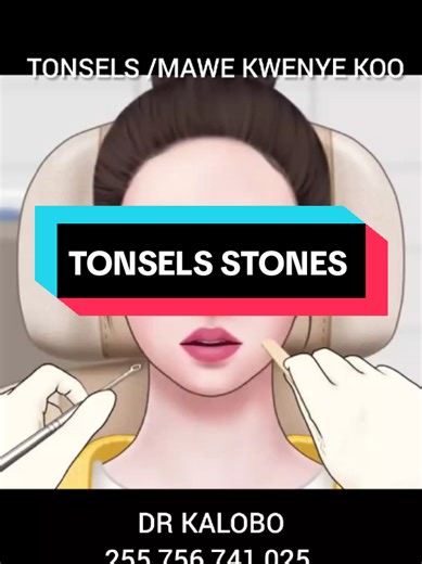 Understanding Tonsil Stones: Causes and Solutions