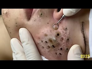 Shocking Deep Blackhead Explosion — Extreme HD Pore Extraction ASMR