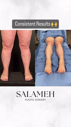 LippyLipo Treatment for Lipedema Lipedema Before and After Transformation #lipedemaawareness