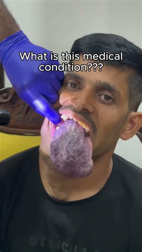Doctors Found This Growing Inside His Tongue...