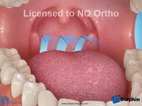 Airway Obstruction Tonsils - Dolphin Aquarium Media.