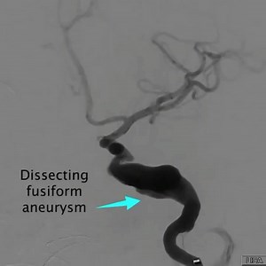 Causes of carotid artery dissection: Heritable connective-tissue disorders Ehlers-Danlos syndrome type IV Fibromuscular dysplasia Cystic medial necrosis Marfan syndrome Autosomal dominant polycystic kidney disease Osteogenesis imperfecta type I Oral contraceptives Hypertension Neck manipulation or strain - This can result from intentional manipulation or from other strain that may occur during sports activities, yoga, or even apparently minimal activity (eg, overhead painting) Blunt trauma from 