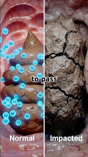 What Happens When You Hold Your Poop Too Long 😳 (Shocking Truth)
