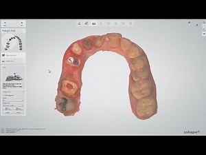 Post and Core on TRIOS® Case