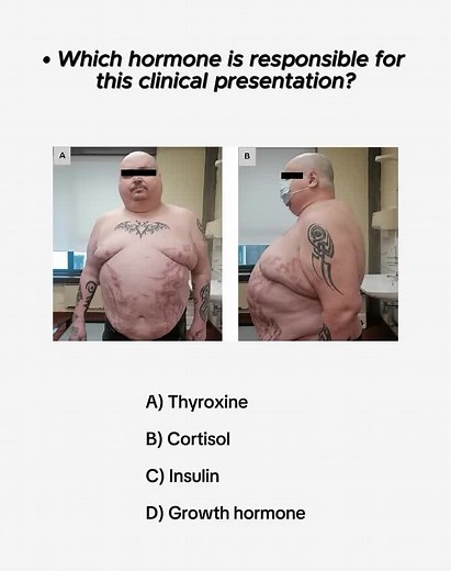 Understanding Cushing's Syndrome: Key Symptoms Explained