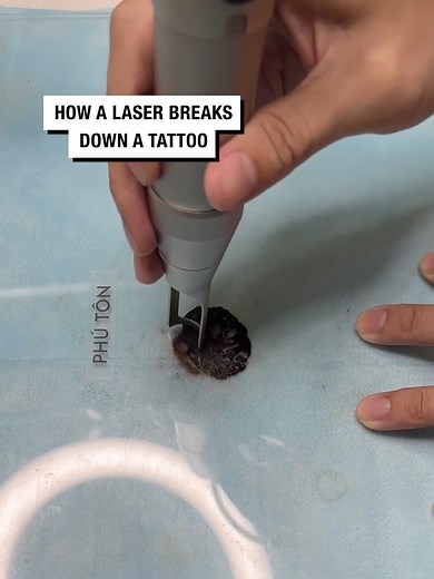 Amazing Laser Tattoo Removal Process! Watch it in Action!