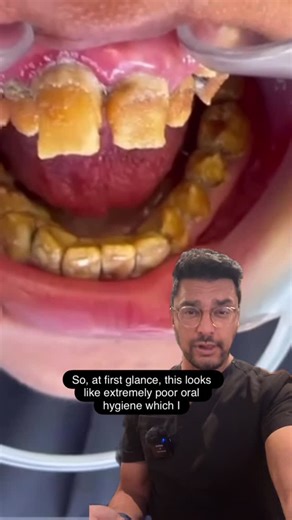 Dentite on Instagram: "🦷 Amelogenesis Imperfecta + Poor Oral Hygiene: Why Things Get Worse Fast Amelogenesis Imperfecta (AI) is a genetic condition where the enamel doesn’t form normally. The enamel may be thin, soft, pitted, discolored, or easily worn down — and that alone makes teeth more vulnerable. But when you add poor oral hygiene on top of AI, the problems multiply: 🔥 What Happens? • Plaque builds up faster because the enamel surface is rough and irregular. • Cavities form more quickly 